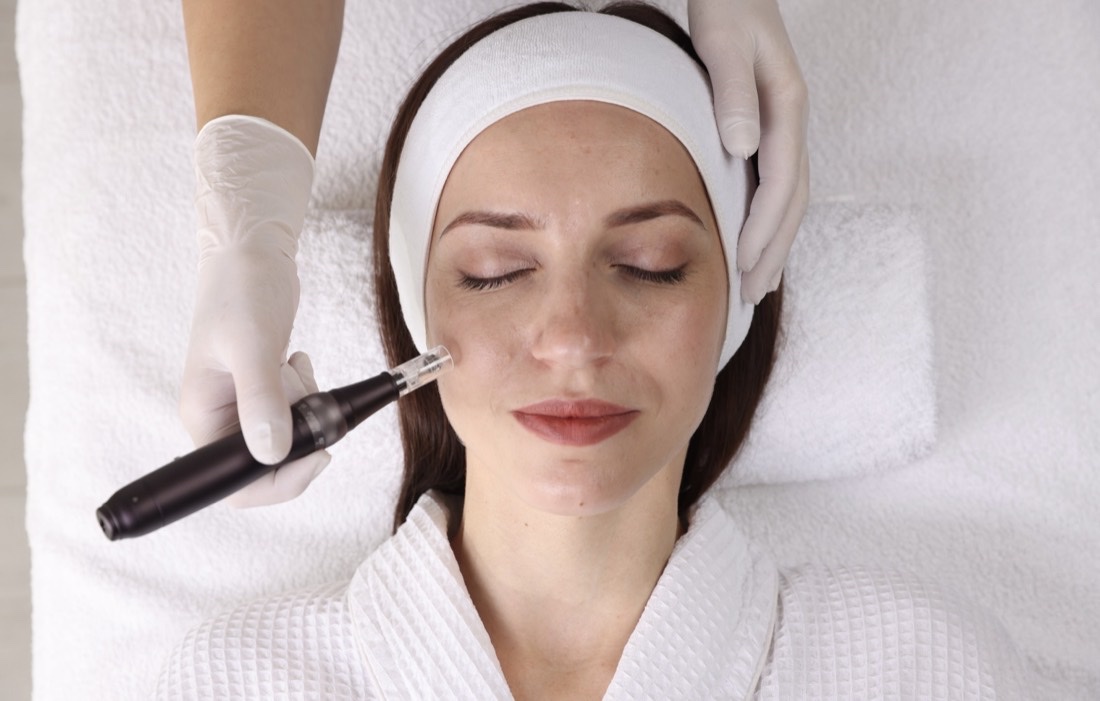 Medical Needling Behandlung